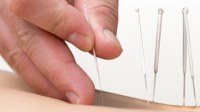 Akupunktioneuloja. Kuva: iStockphoto.